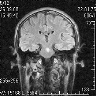 Снимок головного мозга